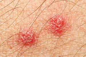 what-bed-bug-bites-look-like what-bed-bug-bites-look-like