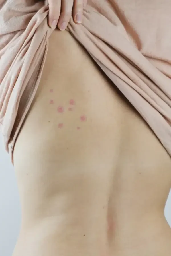 damaged-skin-on-females-back-bedbug-1-qzbkv0n3tx4582ovircr71bmg2dyplteti5s5hak2w